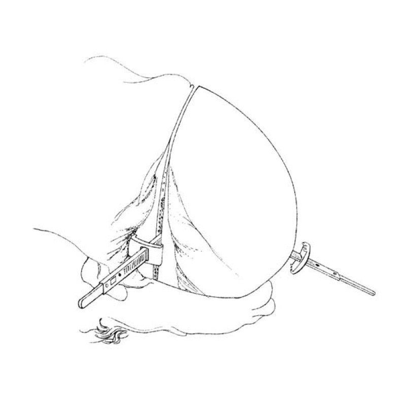Ezi Calvarium Clamps